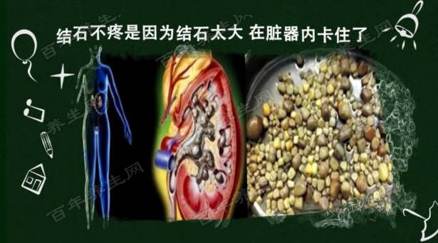 图:肾结石我们应该选择喝白开水,每天的饮水量在2000到3000毫升为